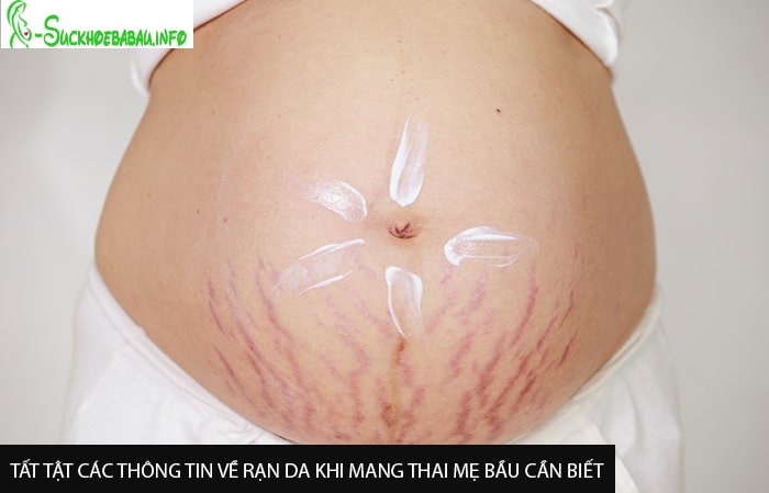 Tất tật các thông tin về rạn da khi mang thai mẹ bầu cần biết